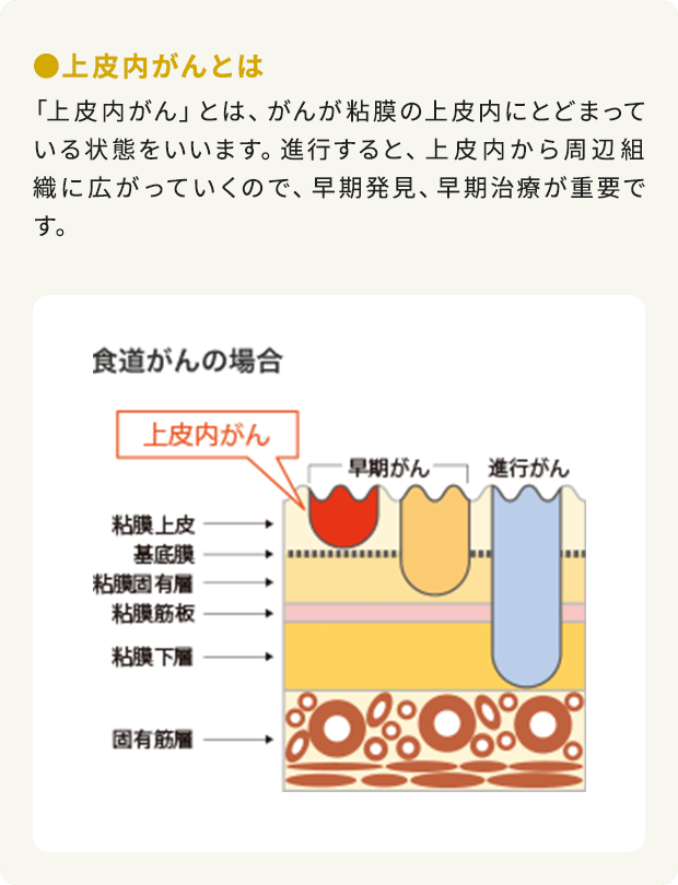 ●上皮内がんとは：「上皮内がん」とは、がんが粘膜の上皮内にとどまっている状態をいいます。進行すると、上皮内から周辺組織に広がっていくので、早期発見、早期治療が重要です。