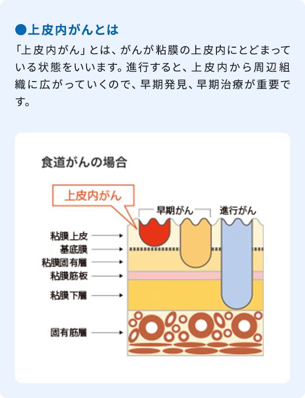 ●上皮内がんとは：「上皮内がん」とは、がんが粘膜の上皮内にとどまっている状態をいいます。進行すると、上皮内から周辺組織に広がっていくので、早期発見、早期治療が重要です。