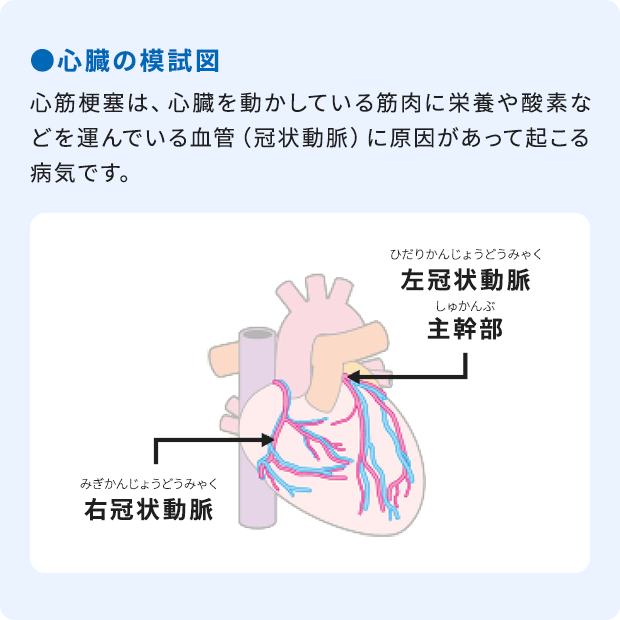 ●心臓の模試図：心筋梗塞は、心臓を動かしている筋肉に栄養や酸素などを運んでいる血管（冠状動脈）に原因があって起こる病気です。