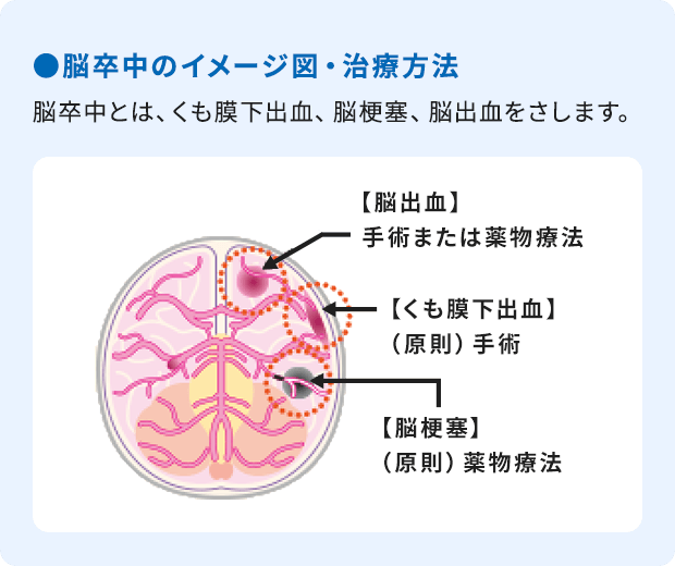 ●脳卒中のイメージ図・治療方法：脳卒中とは、くも膜下出血、脳梗塞、脳出血をさします。