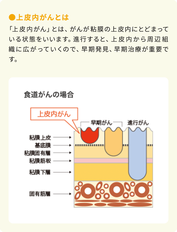 ●上皮内がんとは：「上皮内がん」とは、がんが粘膜の上皮内にとどまっている状態をいいます。進行すると、上皮内から周辺組織に広がっていくので、早期発見、早期治療が重要です。