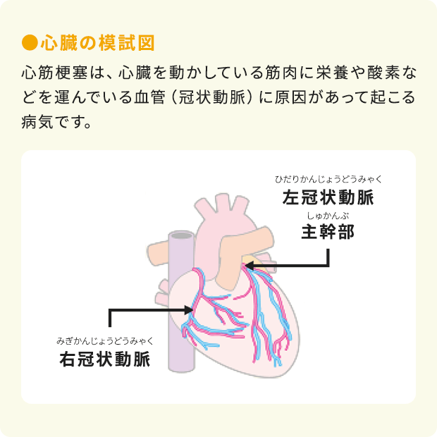 ●心臓の模試図：心筋梗塞は、心臓を動かしている筋肉に栄養や酸素などを運んでいる血管（冠状動脈）に原因があって起こる病気です。