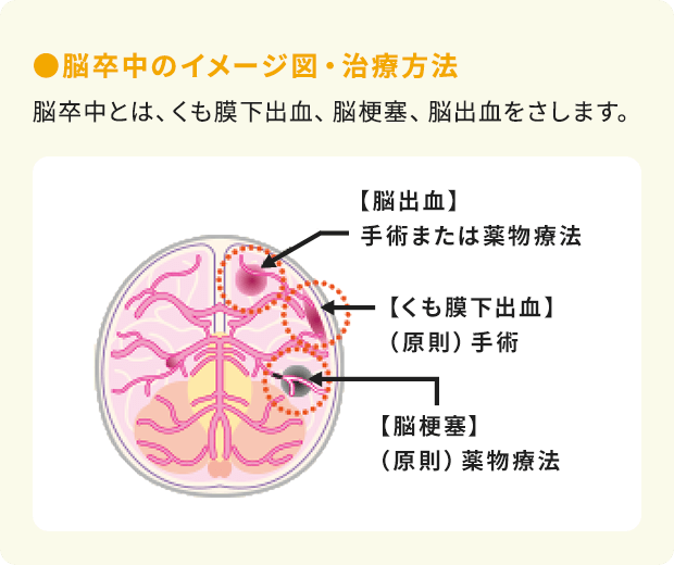 ●脳卒中のイメージ図・治療方法：脳卒中とは、くも膜下出血、脳梗塞、脳出血をさします。