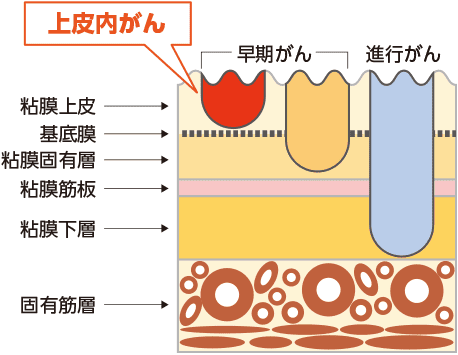 上皮内がん